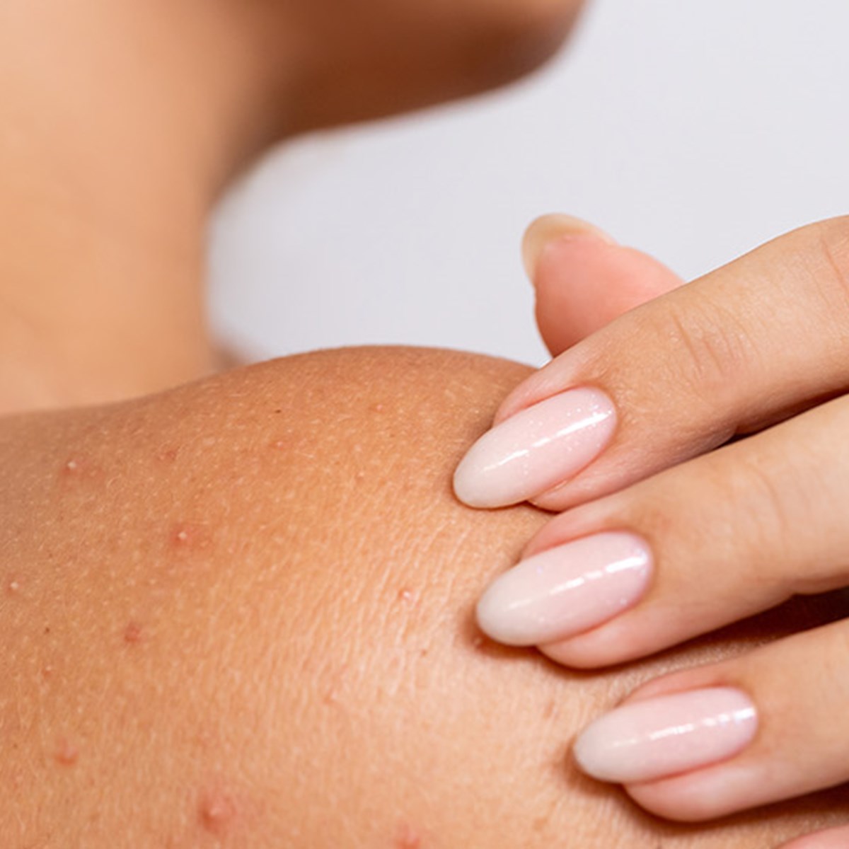 Potničky, čo vlastne sú a ako im predchádzať: Vysvetľuje dermatologička ...
