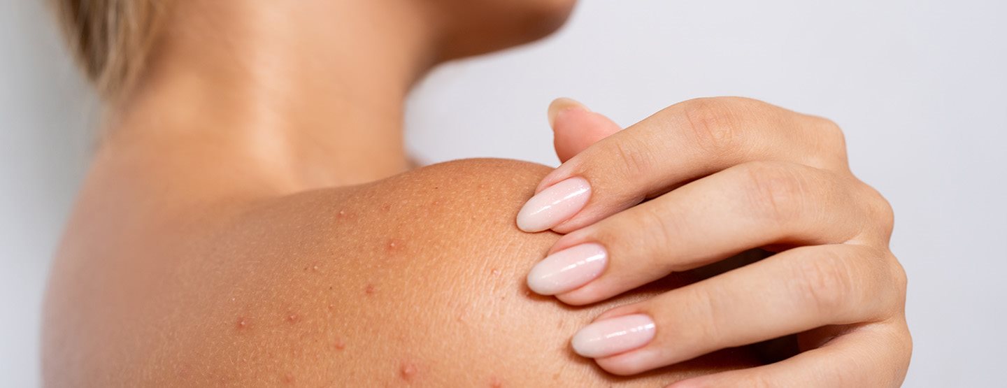 Potničky, čo vlastne sú a ako im predchádzať: Vysvetľuje dermatologička 