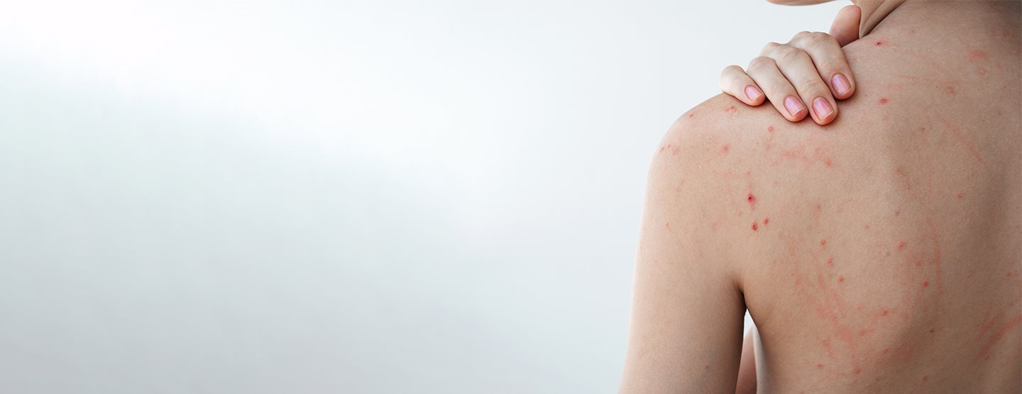 Vyrážky na chrbte: čo podľa dermatologičky pomáha pri akné na chrbte