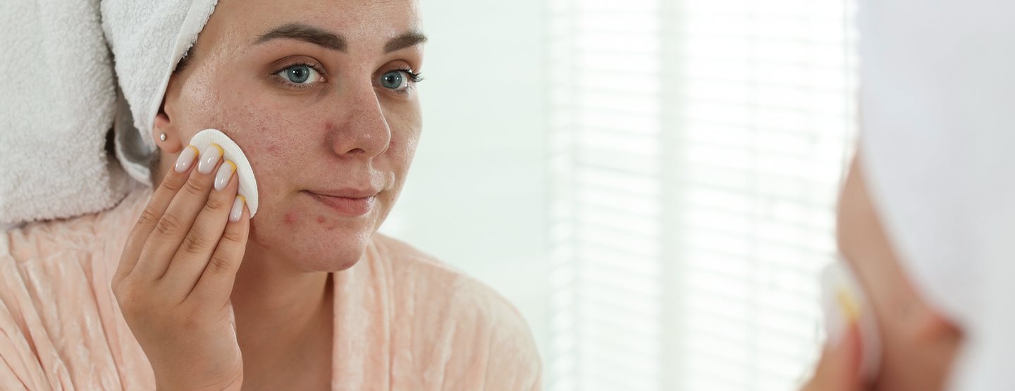Akné v dospelosti: čo pomáha