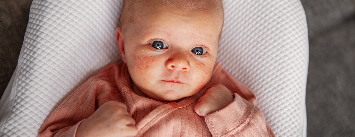 Detské akné: Detská dermatologička radí 