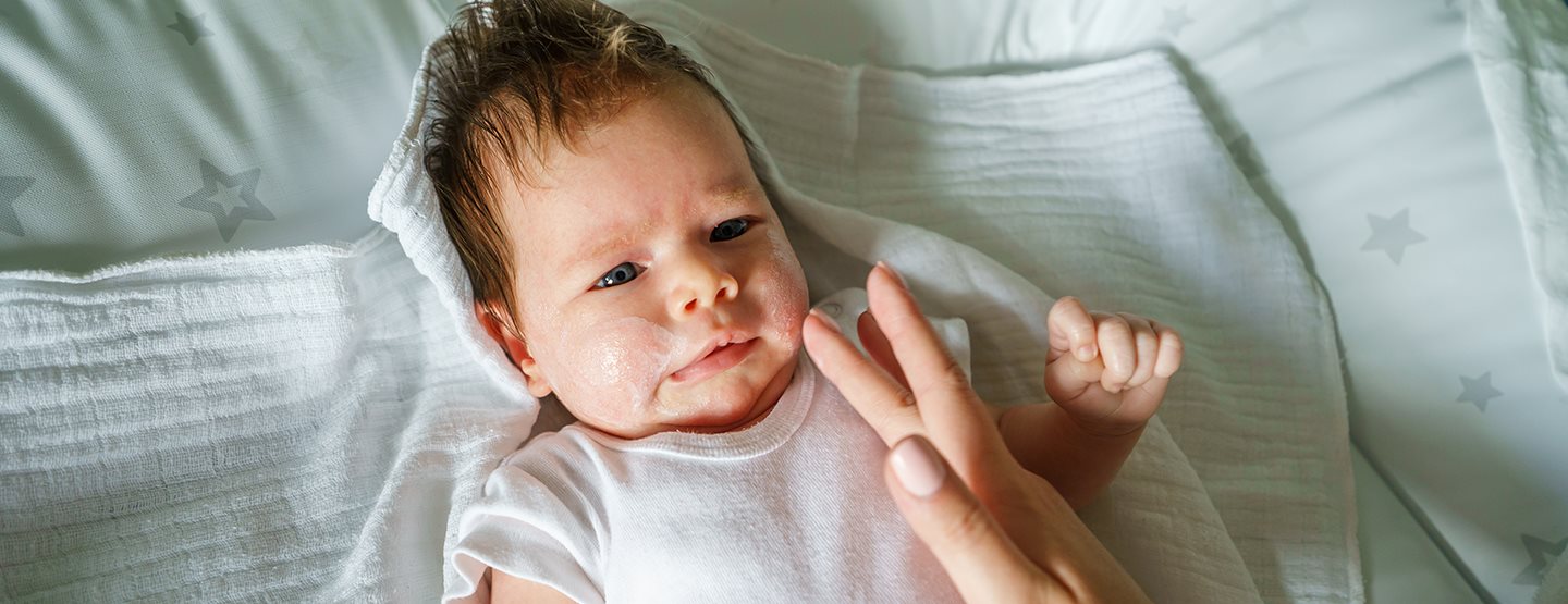 Atopický ekzém u bábätiek a detí: Detská dermatologička vysvetľuje, čo by mali rodičia vedieť 
