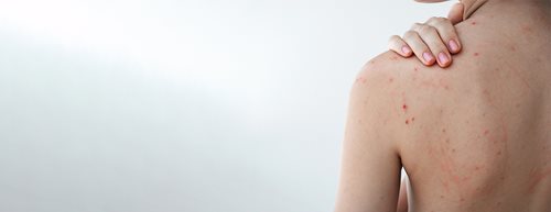 Vyrážky na chrbte: čo podľa dermatologičky pomáha pri akné na chrbte