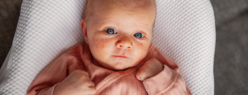 Detské akné: Detská dermatologička radí 